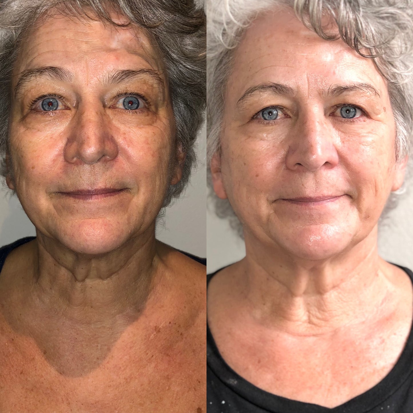 3 SWiCH Treatments for $450 ($120 savings)